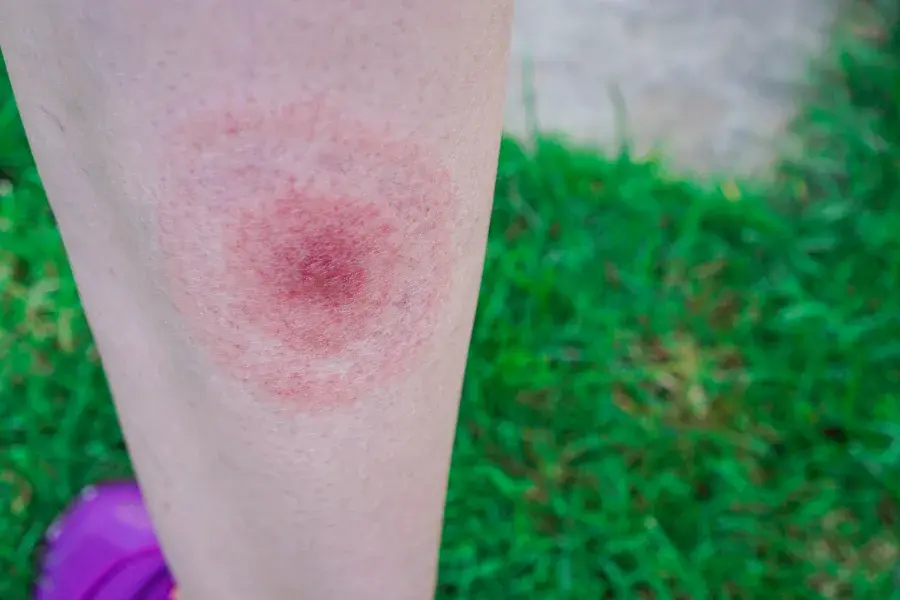 An Erythema Migrans (EM) rash that's shaped like a bullseye