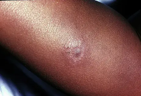Subtle Erythema Migrans (EM) rash, shown on person with darker skin 