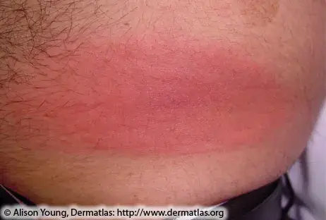 Solid and oval-shaped Lyme rash